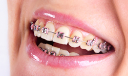 Types of Braces - Dr. Barry White Orthodontics